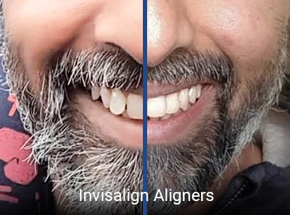 Invisalign Cost Canada