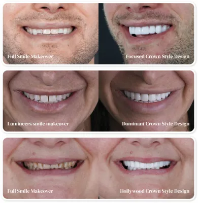 Your smile transformation starts here: Explore dental crown treatments at Smile Masters in Mexico City.