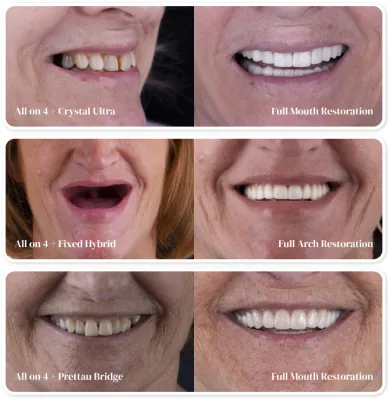 Transformative before-and-after results of All-on-4 dental implants at Smile Masters by Franklin Clinic in Mexico City