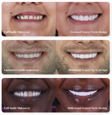 Gallery of stunning smile transformations achieved through high-quality dental veneers at Smile Masters by Franklin.